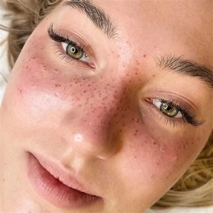 Are freckles permanent?