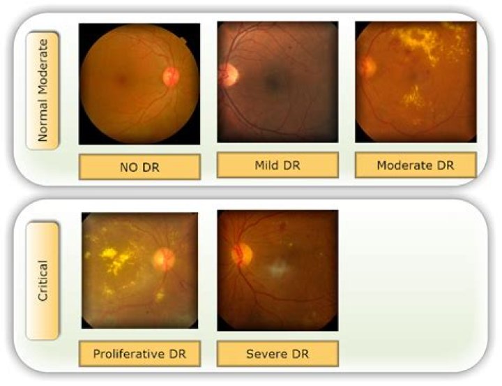 Can a retinal scan detect diabetes?