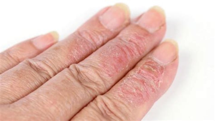 Can acrylic nails cause eczema?