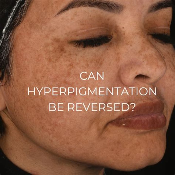 Can hyperpigmentation be cured completely?