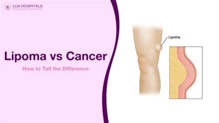 Can lipomas become cancerous?