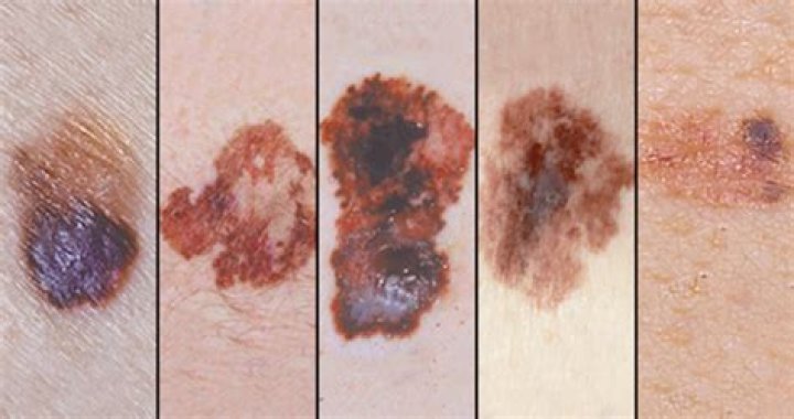 Can melanomas come and go?