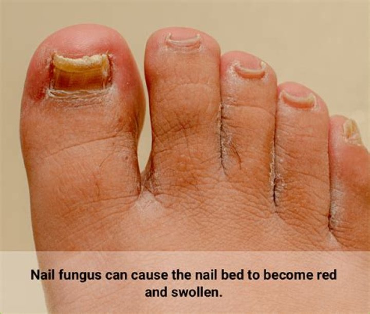 Can toenail fungus cause swollen lymph nodes?