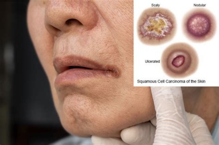 Can you have squamous cell carcinoma for years?