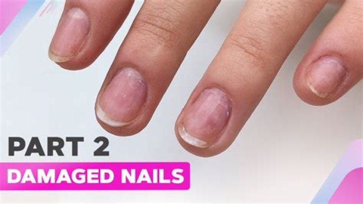 Can you repair a damaged nail bed?