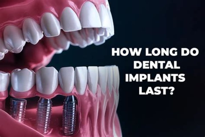 Do dental implants hurt long-term?