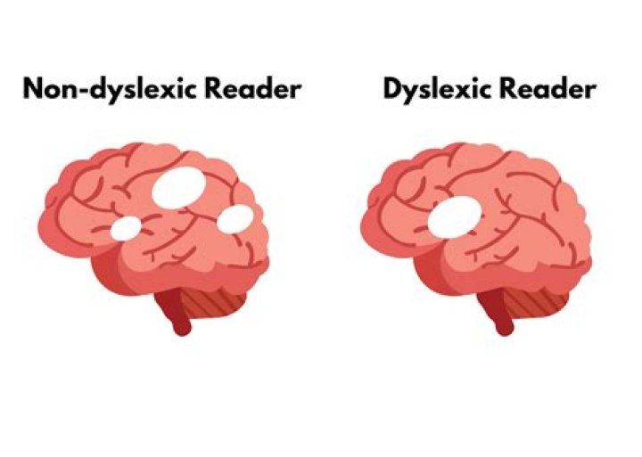 Do dyslexics have good memory?