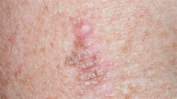 Do melanomas look shiny?