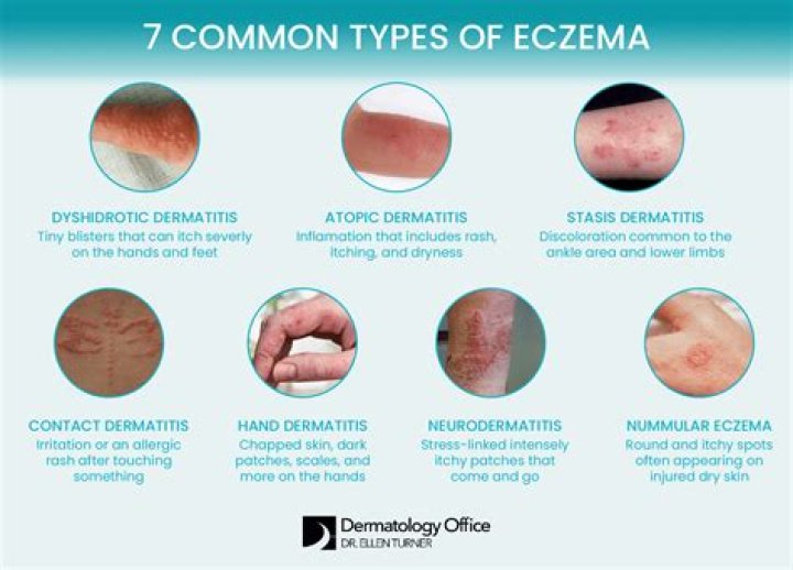 Does cold make eczema worse?