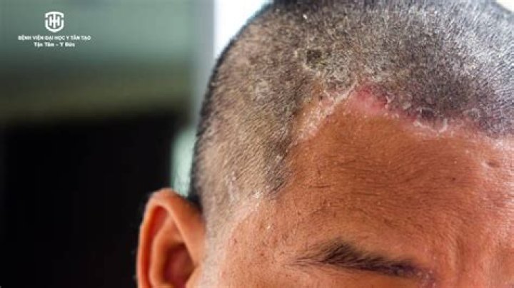 Does Head sweat cause dandruff?