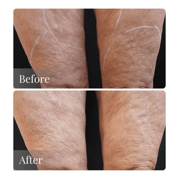 Does microneedling tighten skin on legs?