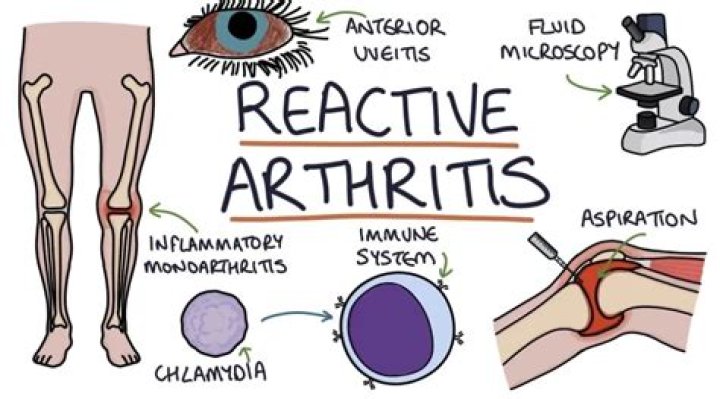 Does reactive arthritis go away?