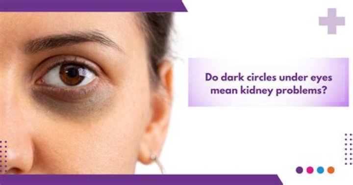 Does sugar cause dark circles?