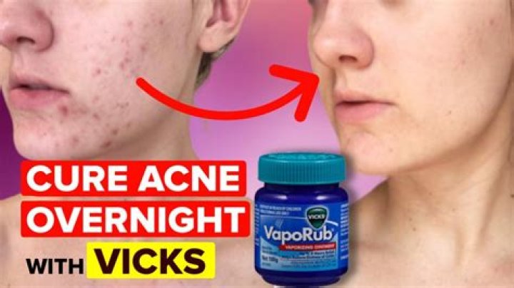 Does Vicks help with pimples?