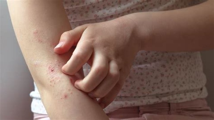 How can I help my child with eczema?