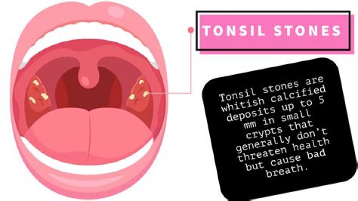 How do you get rid of tonsil stones permanently?