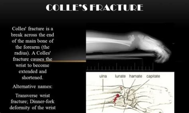 How painful is a Colles fracture?