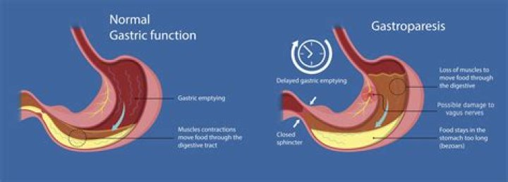 Is gastroparesis long life?