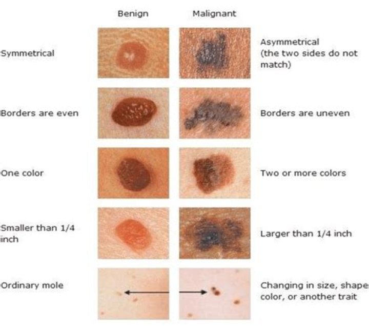 Is melanoma benign or malignant?