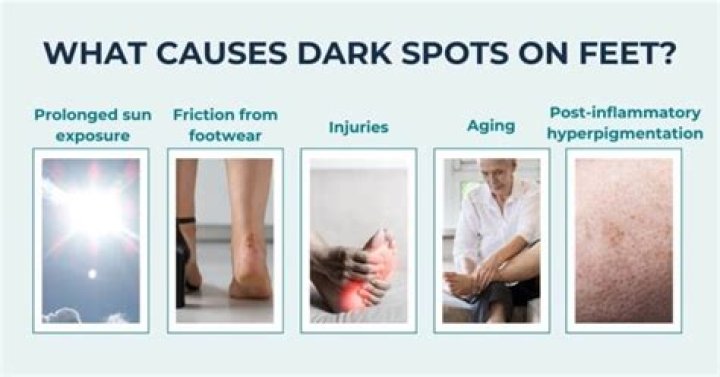 What causes dark spots on feet?
