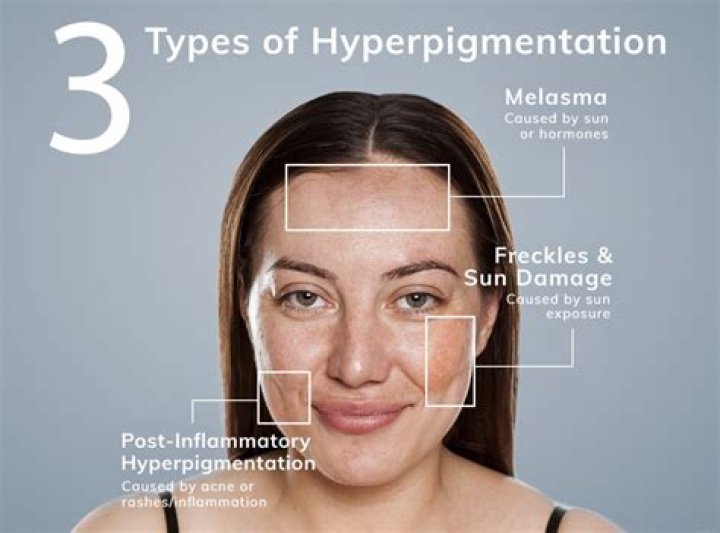 What causes pigmentation on face?
