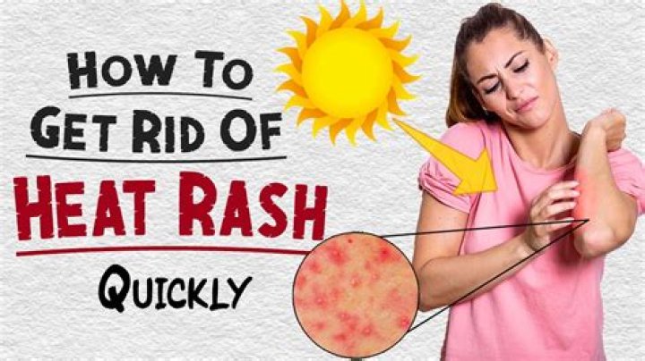What cures heat rash fast?