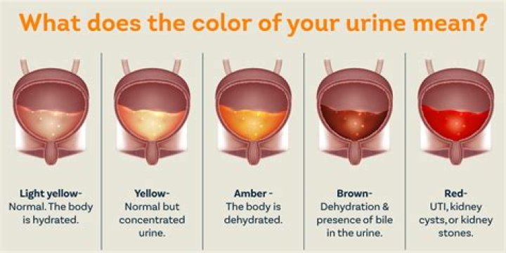 What does urine from a UTI look like?
