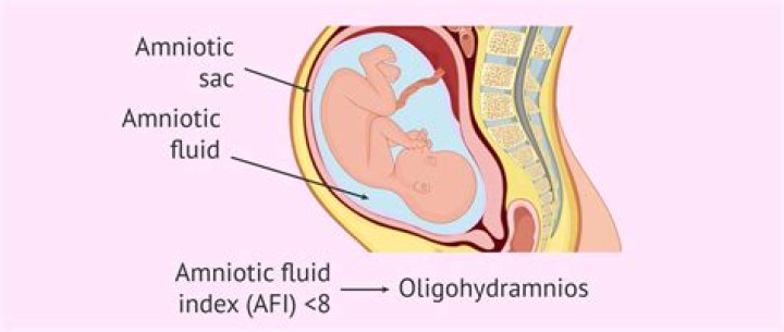 What happens if baby drinks amniotic fluid during birth?