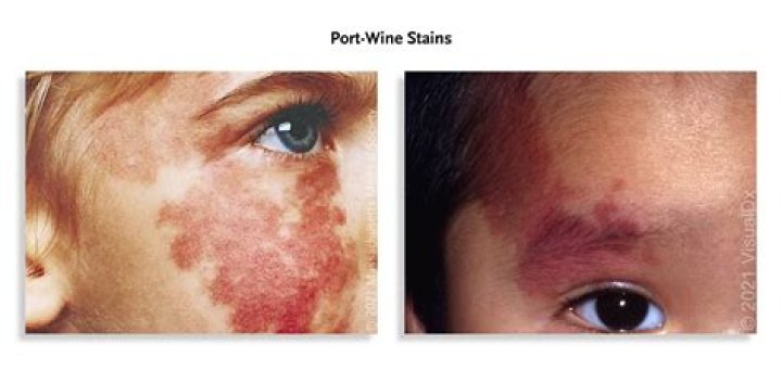 When do stork bites start to fade?