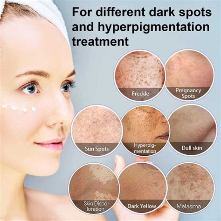 Which is the best cream for pigmentation and dark spots?